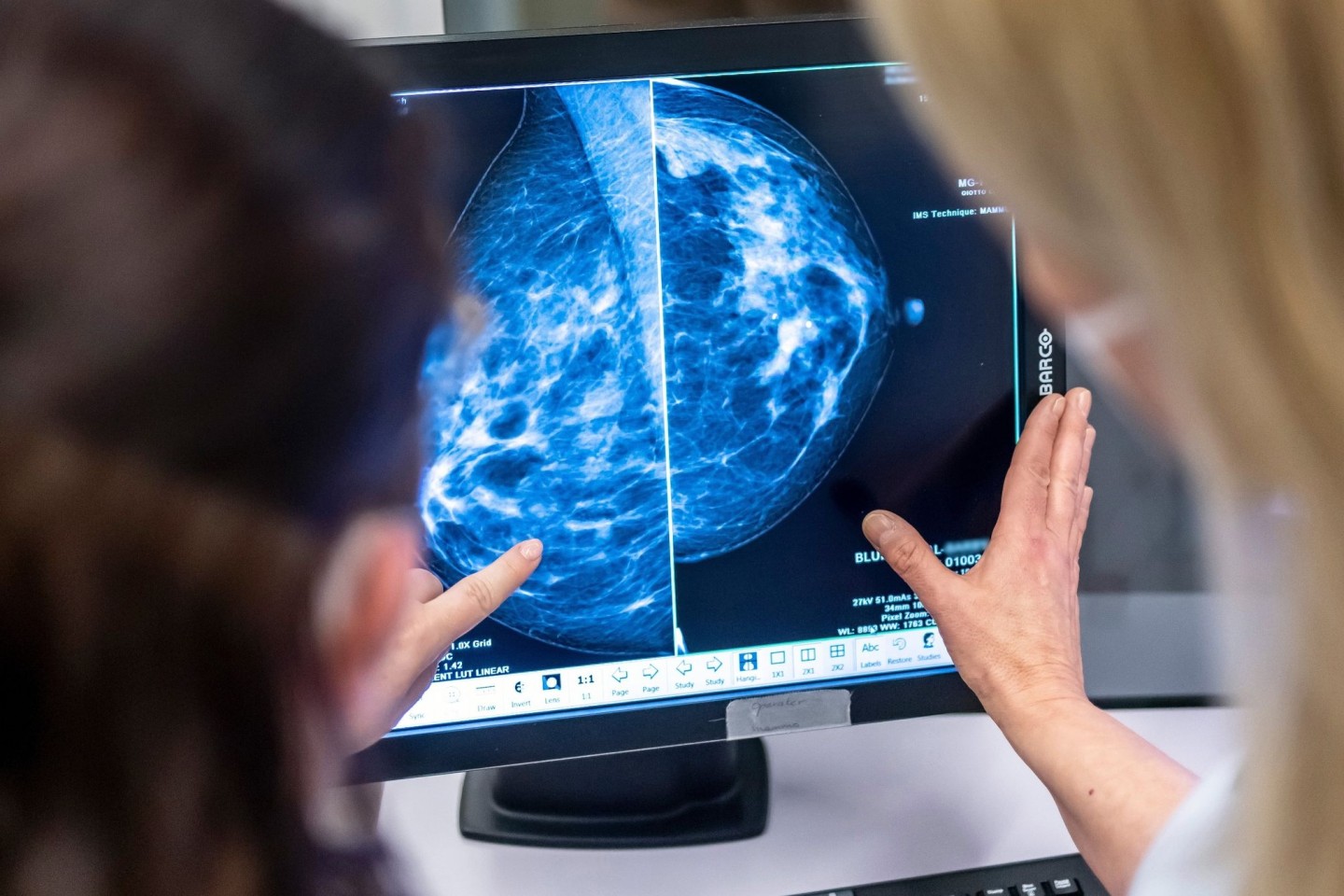 Medizinisches Personal untersucht mit einer Mammographie die Brust einer Frau auf Brustkrebs.